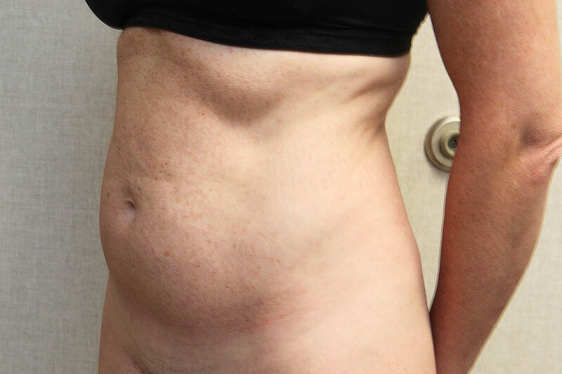 CoolSculpting Before & After Patient Photo