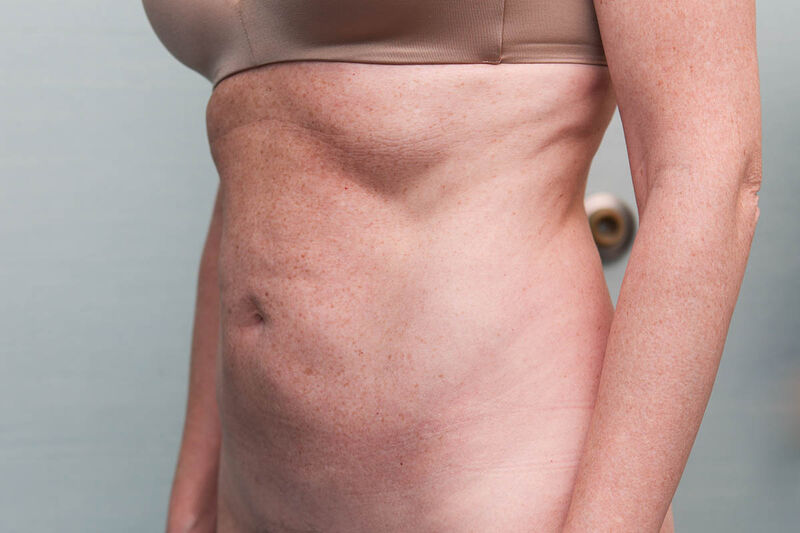 CoolSculpting Before & After Patient Photo