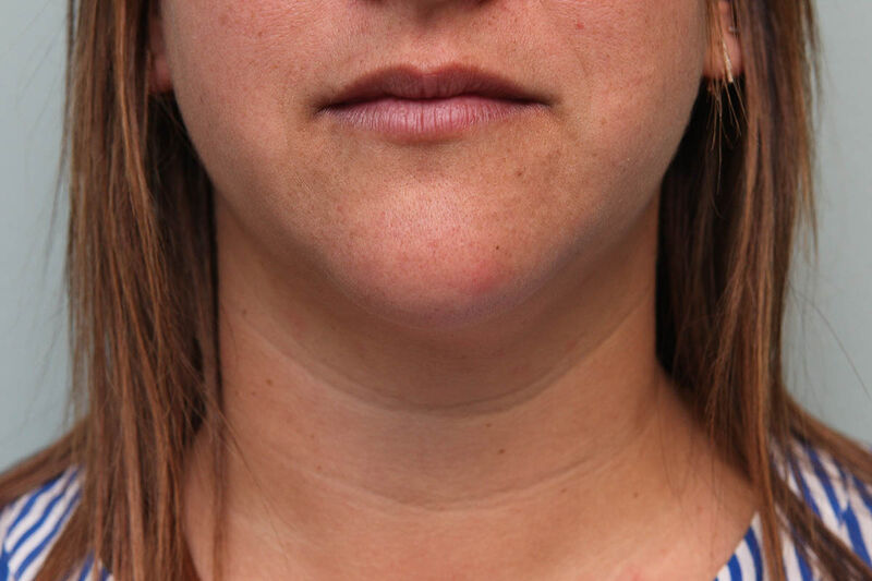 CoolSculpting Before & After Patient Photo