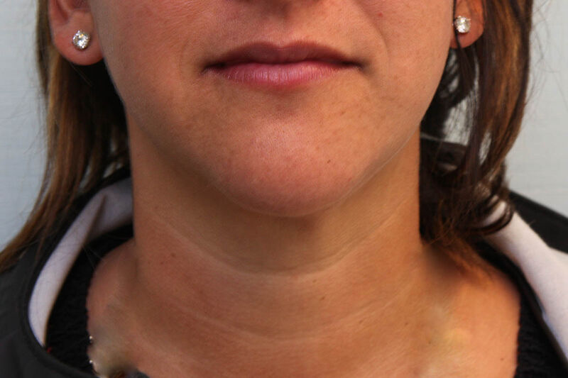 CoolSculpting Before & After Patient Photo