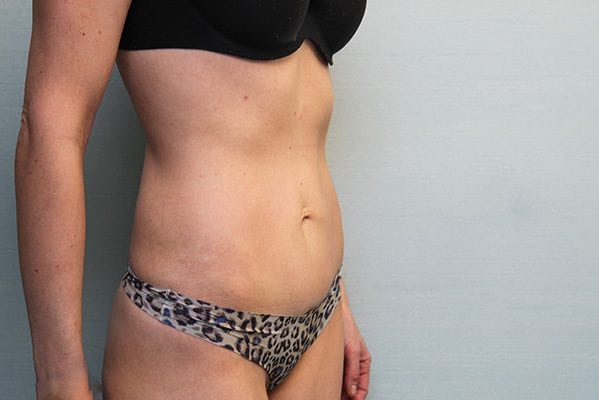 CoolSculpting Before & After Patient Photo