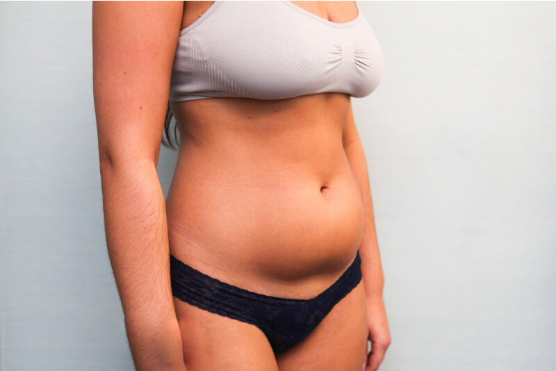Liposuction Abdomen Before & After Patient Photo