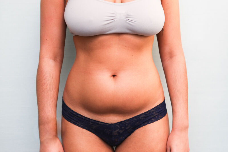 Liposuction Abdomen Before & After Patient Photo