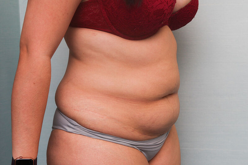 Liposuction Abdomen Before & After Patient Photo