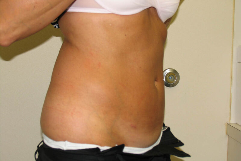 Liposuction Abdomen Before & After Patient Photo