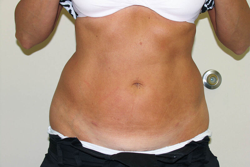 Liposuction Abdomen Before & After Patient Photo