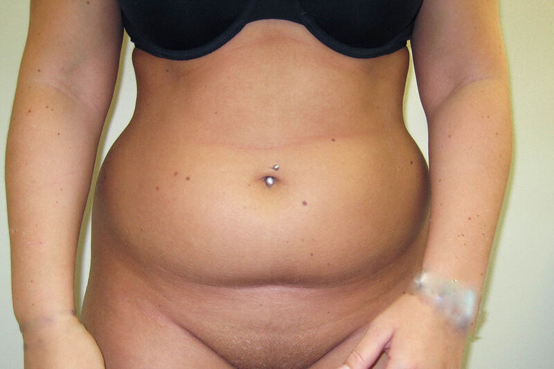 Liposuction Abdomen Before & After Patient Photo