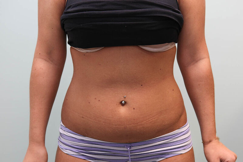 Liposuction Abdomen Before & After Patient Photo