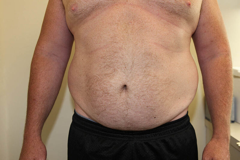 Liposuction Abdomen Before & After Patient Photo