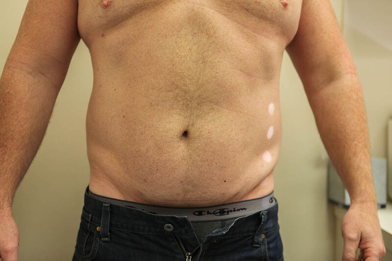 Liposuction Abdomen Before & After Patient Photo