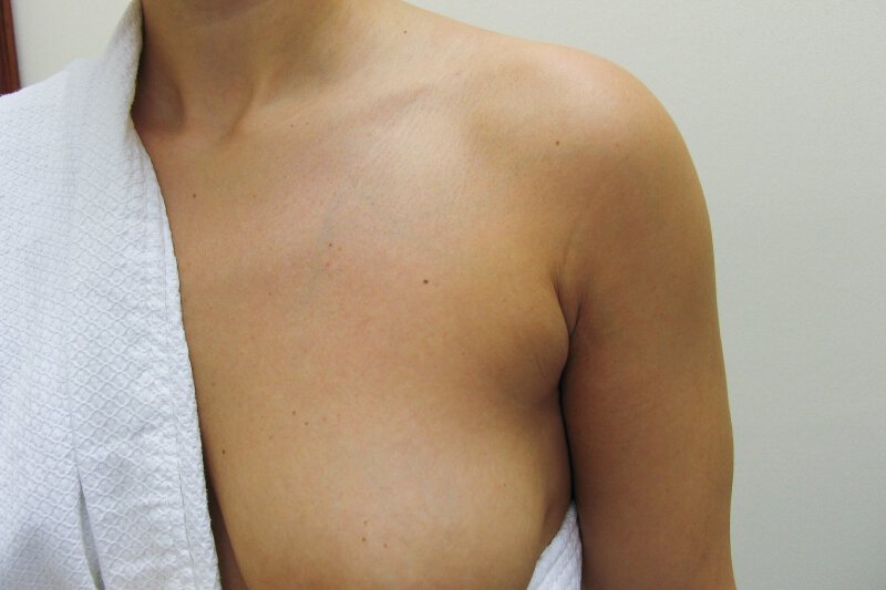 Liposuction Chest Before & After Patient Photo