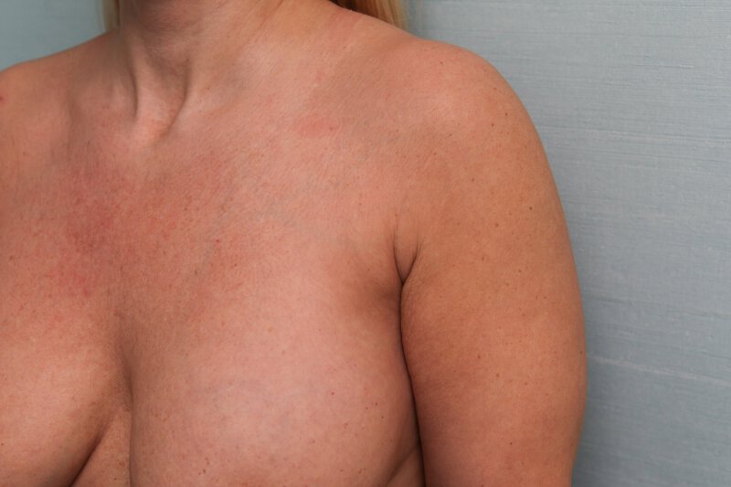 Liposuction Chest Before & After Patient Photo