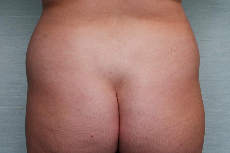 Liposuction Flank Before & After Patient Photo