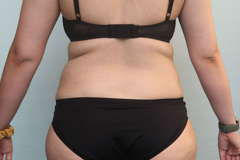 Liposuction Flank Before & After Patient Photo