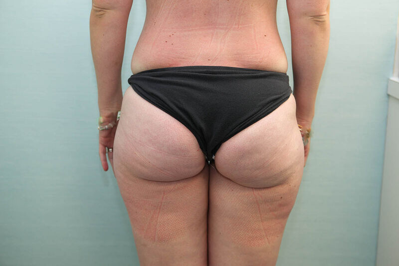 Liposuction Hips and Thighs Before & After Patient Photo