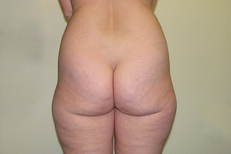 Liposuction Hips and Thighs Before & After Patient Photo