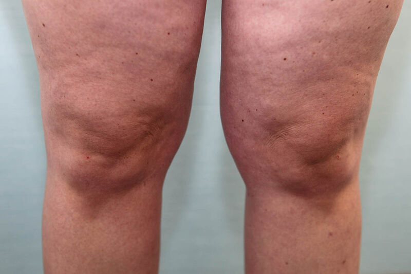 Liposuction Hips and Thighs Before & After Patient Photo