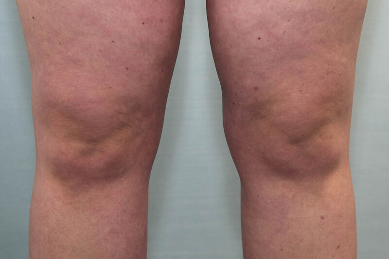 Liposuction Hips and Thighs Before & After Patient Photo