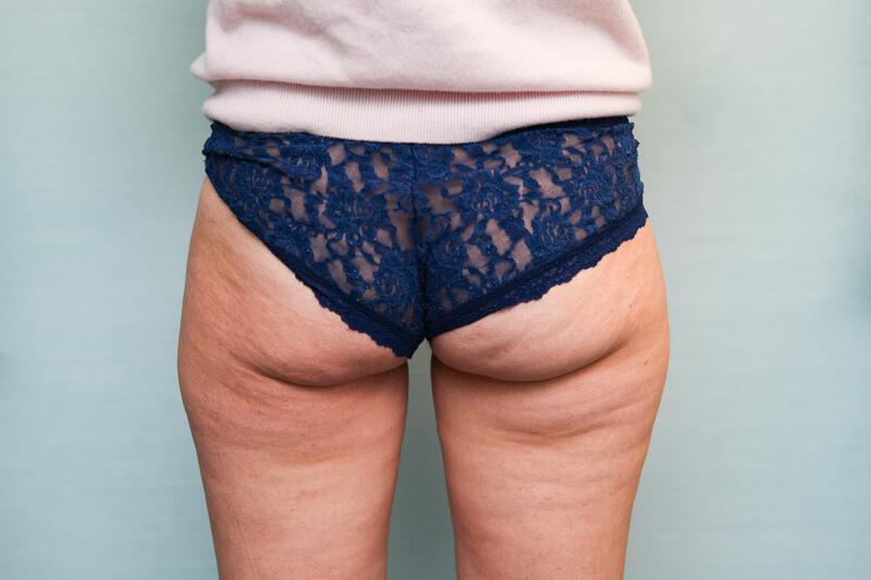 Liposuction Hips and Thighs Before & After Patient Photo