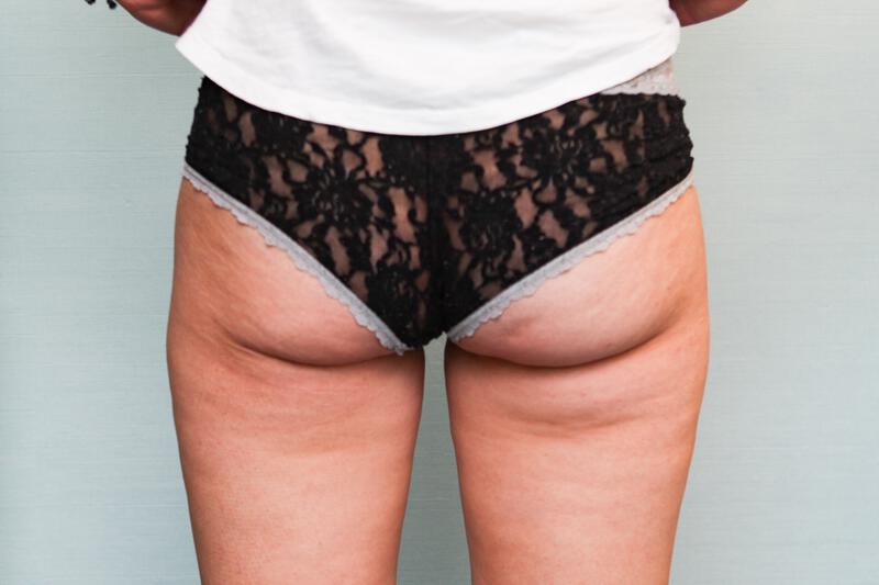 Liposuction Hips and Thighs Before & After Patient Photo