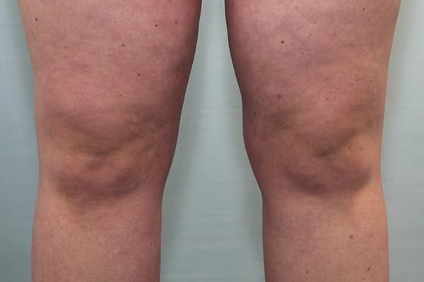 Liposuction Knees Before & After Patient Photo