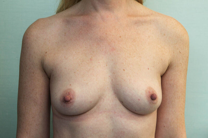 Breast Augmentation with Saline Implants Before & After Patient Photo