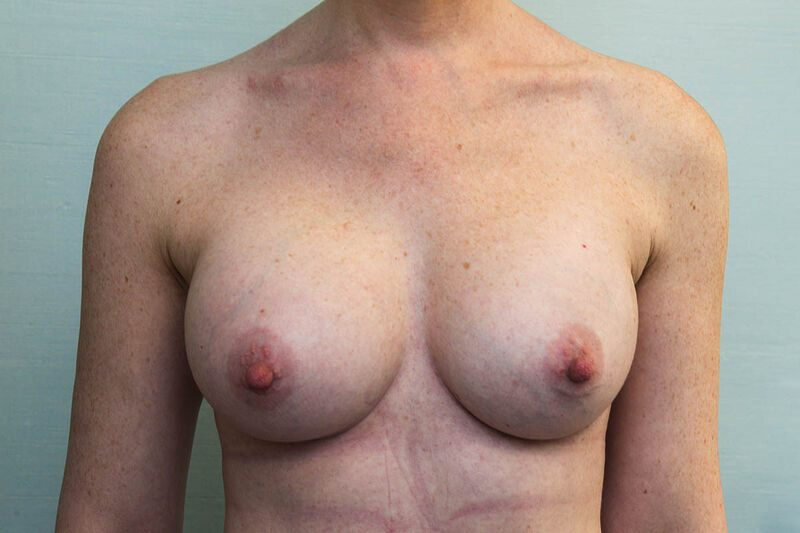 Breast Augmentation with Saline Implants Before & After Patient Photo