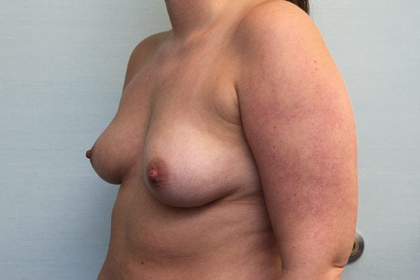 Breast Augmentation with Saline Implants Before & After Patient Photo
