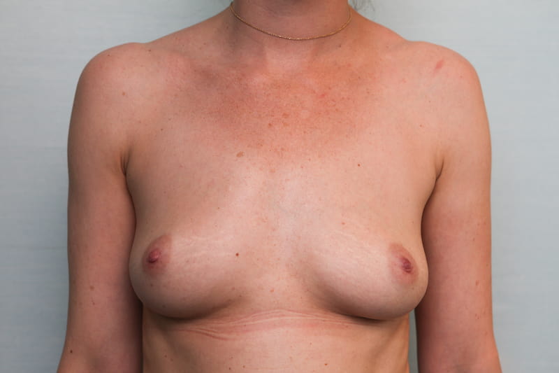 Breast Augmentation with Saline Implants Before & After Patient Photo