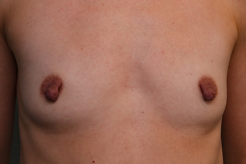 Breast Augmentation Before & After Patient Photo