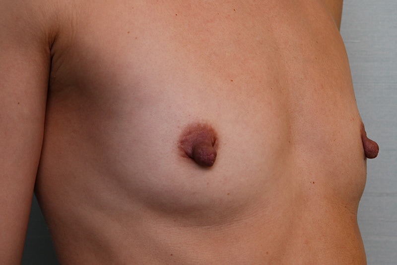 Breast Augmentation Before & After Patient Photo