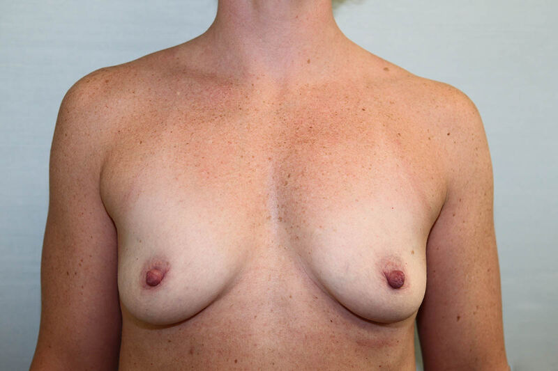 Breast Augmentation Before & After Patient Photo