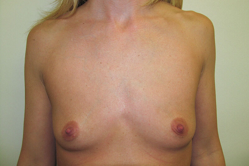 Breast Augmentation Before & After Patient Photo