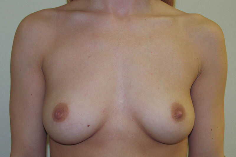 Breast Augmentation Before & After Patient Photo