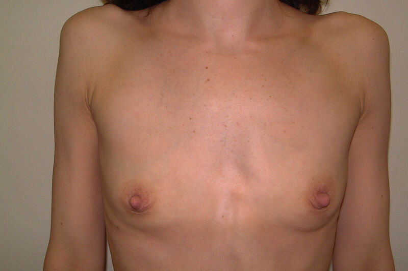 Breast Augmentation Before & After Patient Photo