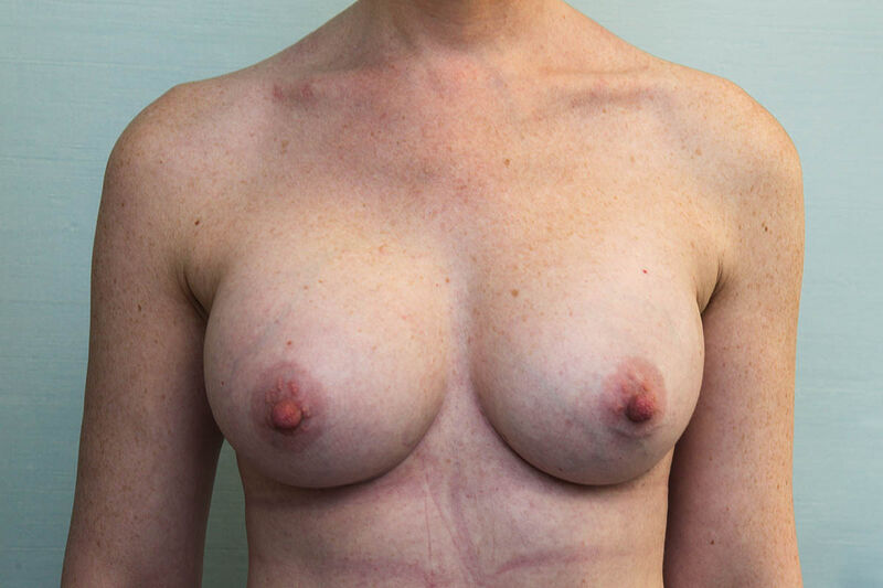 Breast Augmentation Before & After Patient Photo