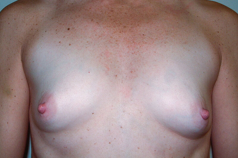 Breast Augmentation Before & After Patient Photo