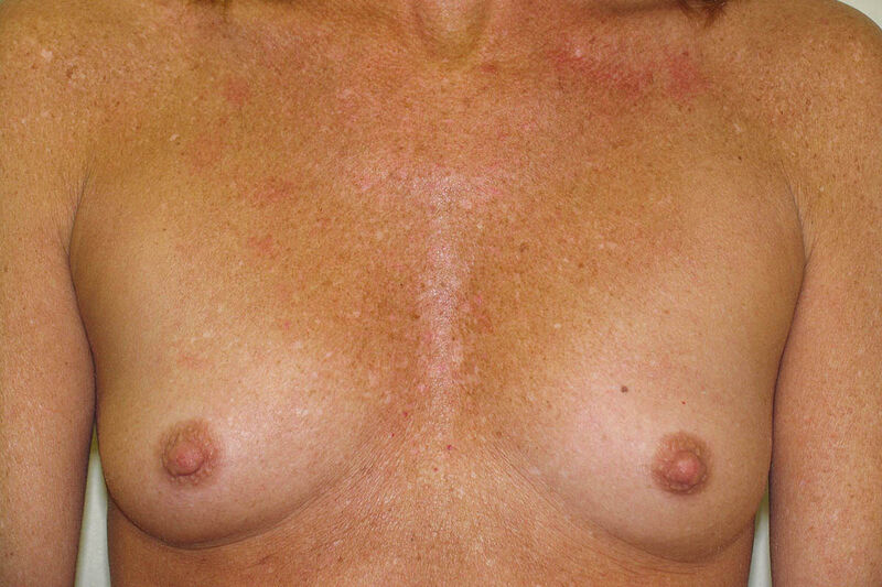 Breast Augmentation Before & After Patient Photo