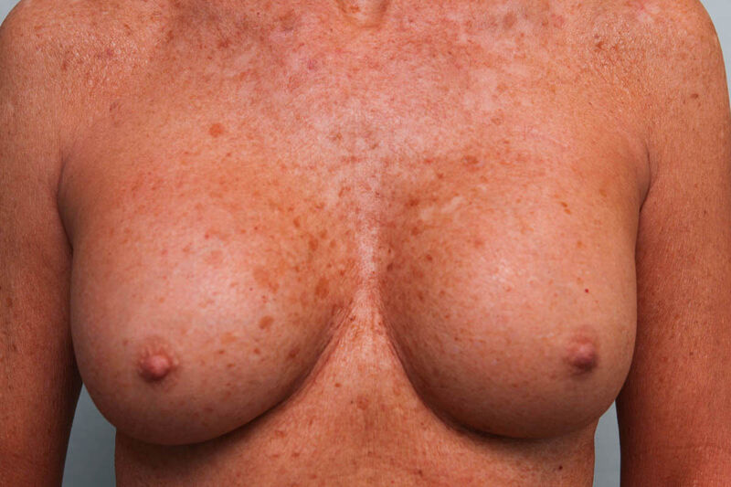 Breast Augmentation Before & After Patient Photo