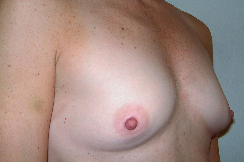 Breast Augmentation Before & After Patient Photo