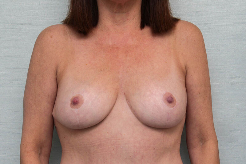 Breast Lift Before & After Patient Photo