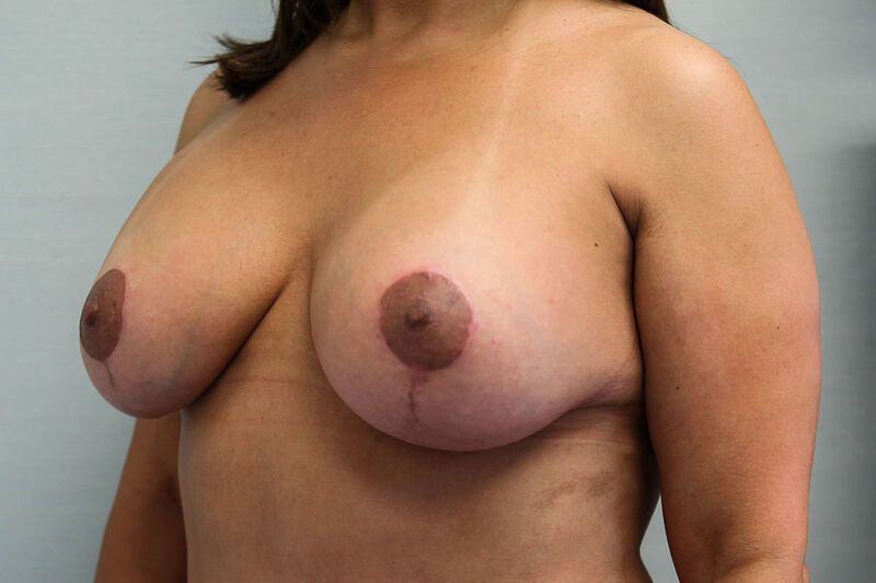 Breast Lift Before & After Patient Photo