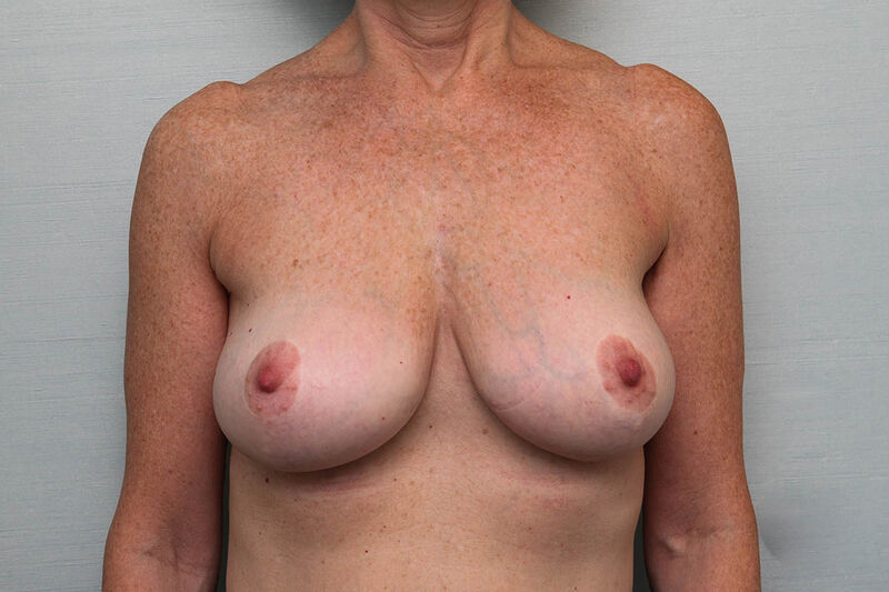 Breast Lift Before & After Patient Photo