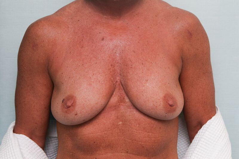 Breast Lift Before & After Patient Photo