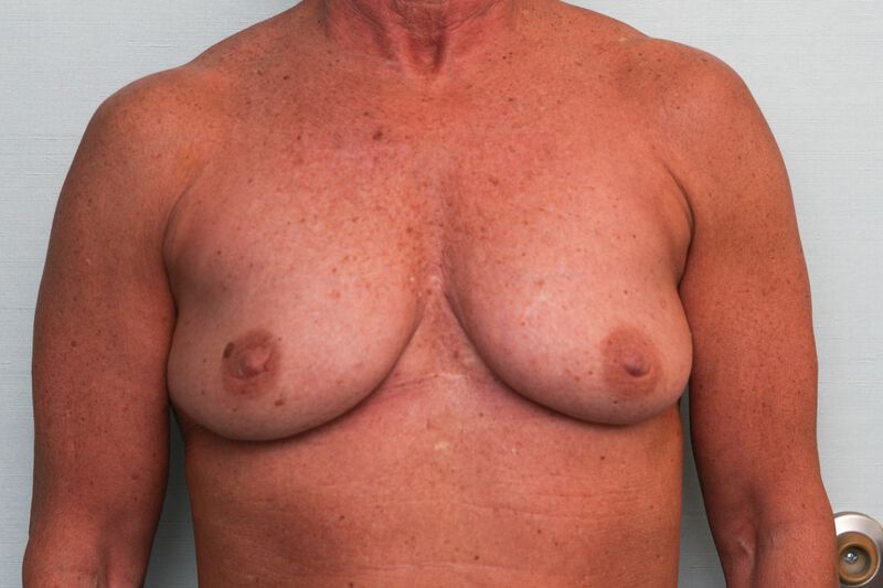 Breast Lift Before & After Patient Photo