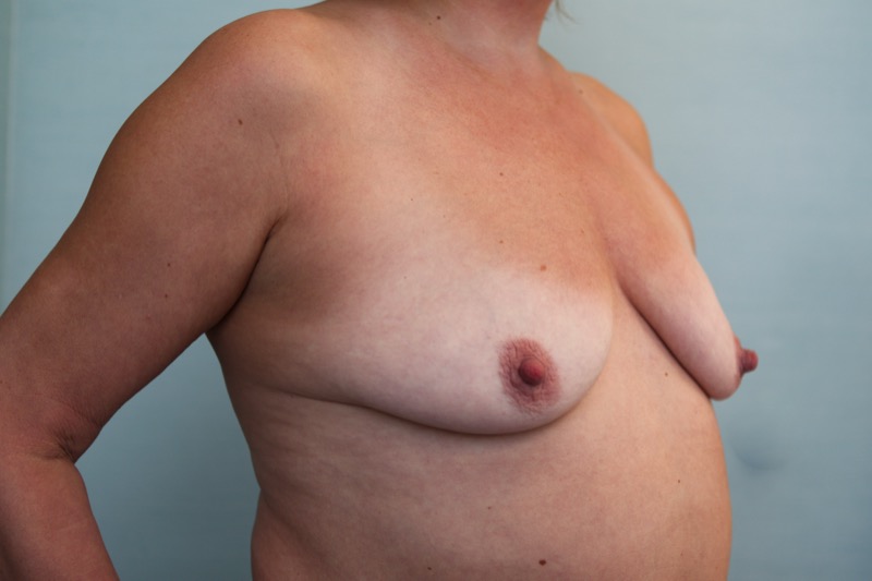 Breast Lift Before & After Patient Photo
