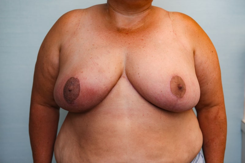 Breast Reduction Before & After Patient Photo