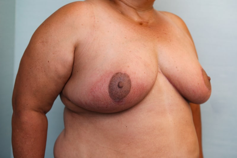 Breast Reduction Before & After Patient Photo