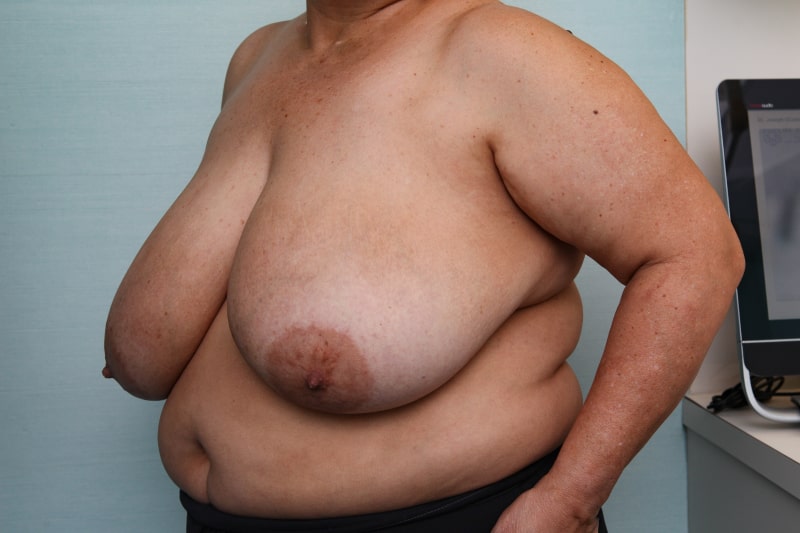 Breast Reduction Before & After Patient Photo