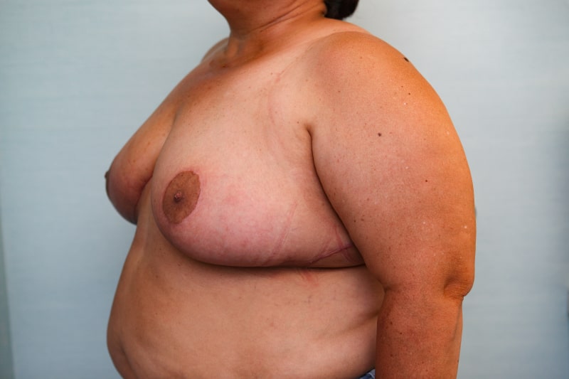 Breast Reduction Before & After Patient Photo